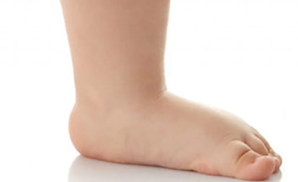 Flat Feet