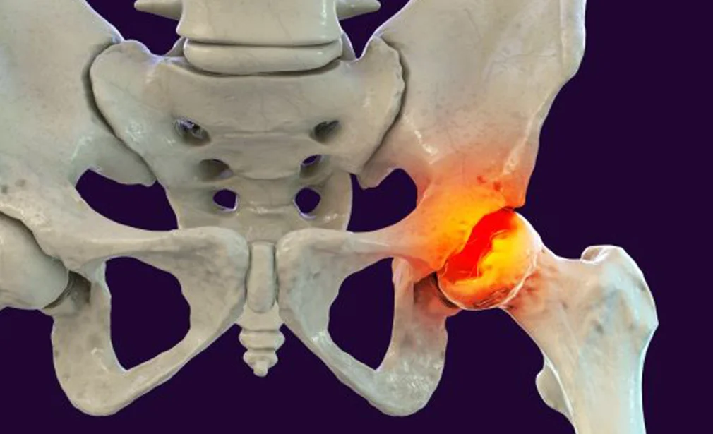 Perthes Disease