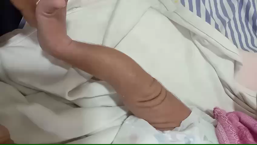 Congenital knee dislocation before treatment