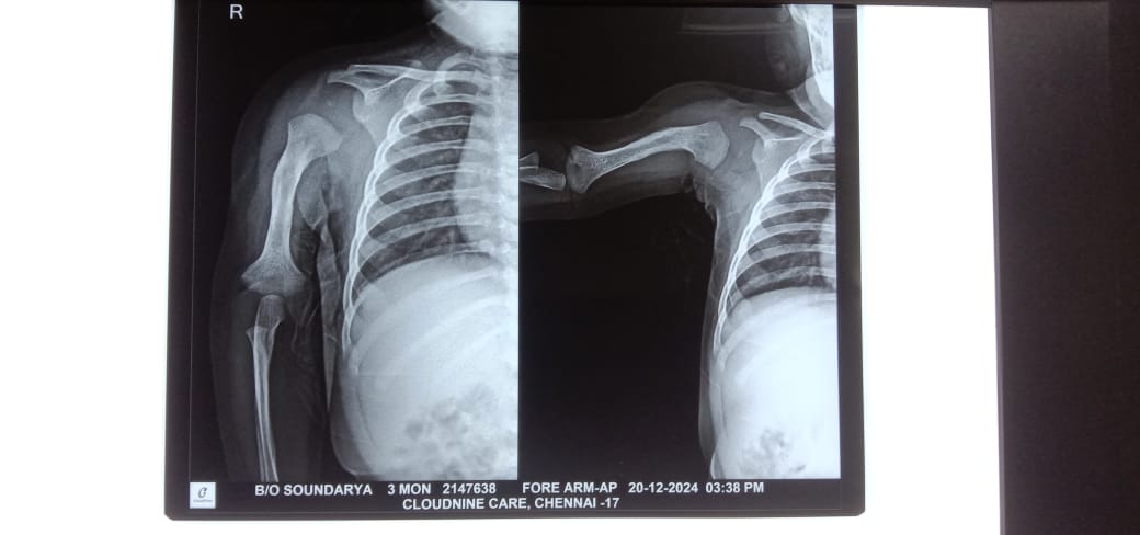 Osteomyelitis humerus after treatment