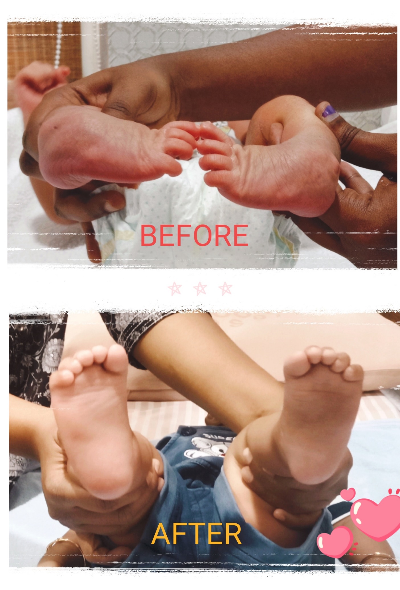 Bilateral clubfoot after treatment