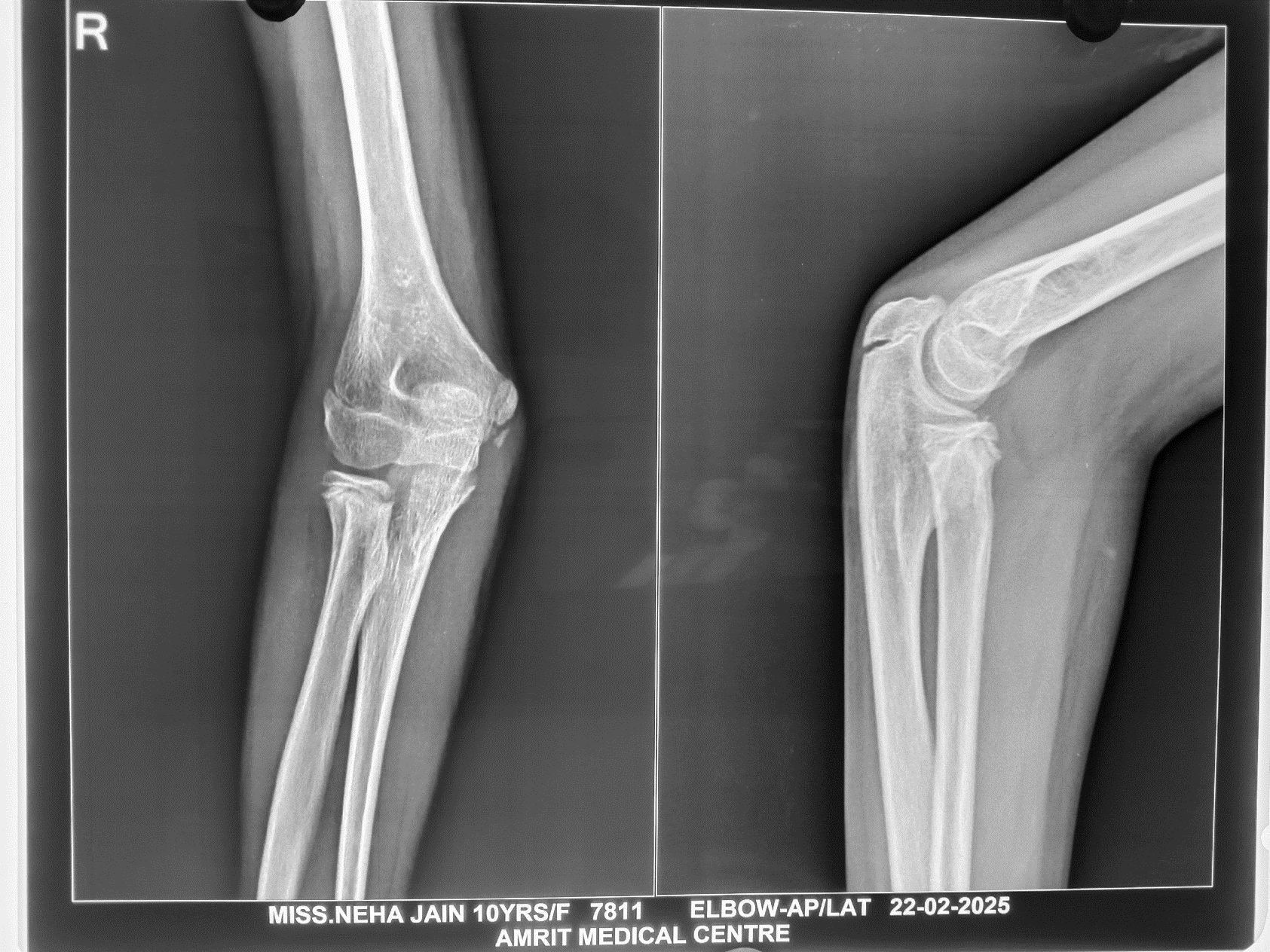 Radial neck fracture after treatment