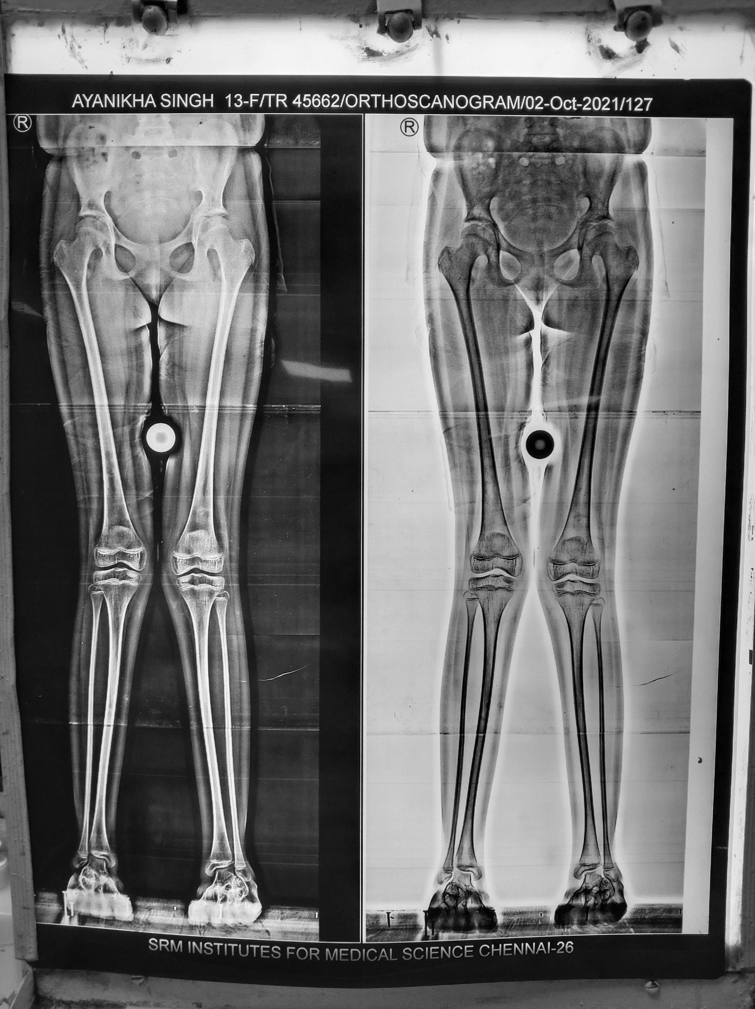 Bilateral genu valgum before treatment