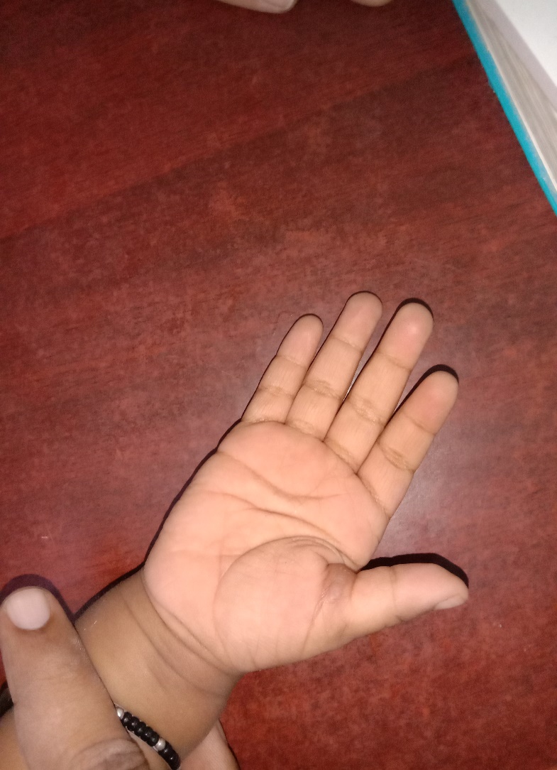 Congenital trigger thumb after treatment